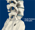 Spondylolysis