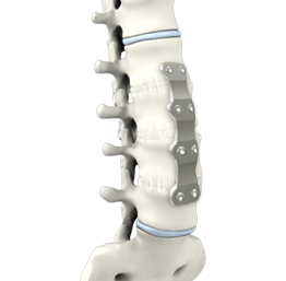 Lumbar Corpectomy and Fusion