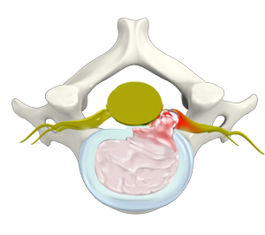 Herniated disc (Cervical)