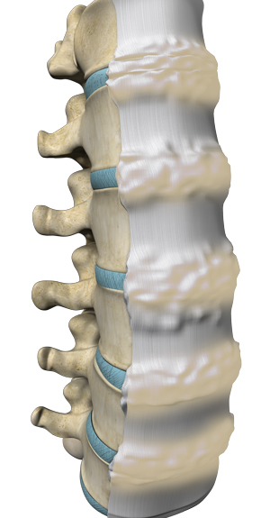 DISH (Diffuse Iliopathic Skeletal Hyperostosis)