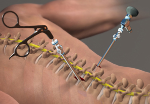 Lumbar Endoscopic Discectomy