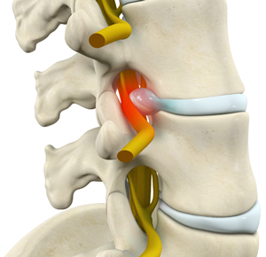  Lumbar Radiculopathy 