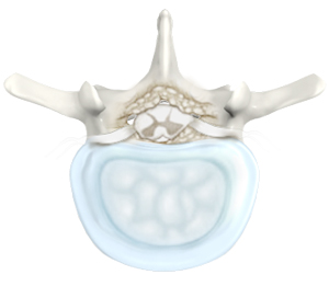 Lumbar Stenosis