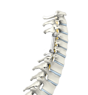 Posterior Cervical Laminectomy and Fusion