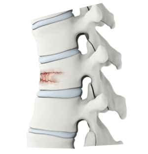 Vertebral Compression Fractures