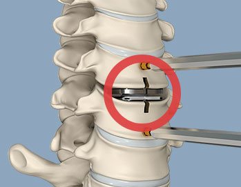 Artificial Cervical Disc Replacement